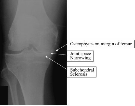 Oestoarthritis core condition