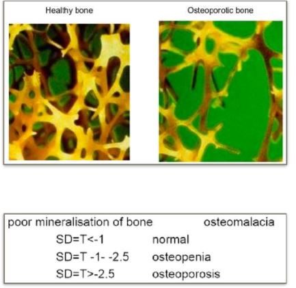 osteoporosis