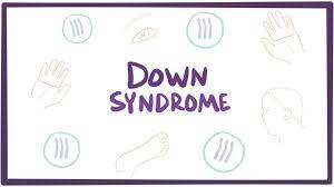 Down Syndrome Essay